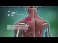 Myofascial pain syndrome and trigger points Reasons