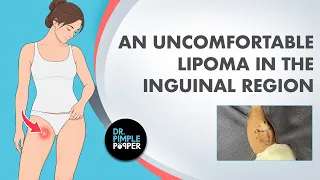 Dr. Pimple Popper vs. The Uncomfortable, Inguinal Lipoma