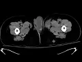 Extraperitoneal bladder rupture