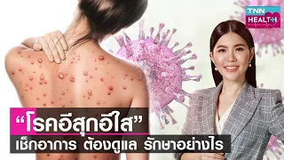 วัคซีนอิสุอีสัยฉีดได้ตั้งแต่อายุเท่าใด และมีกี่เข็ม