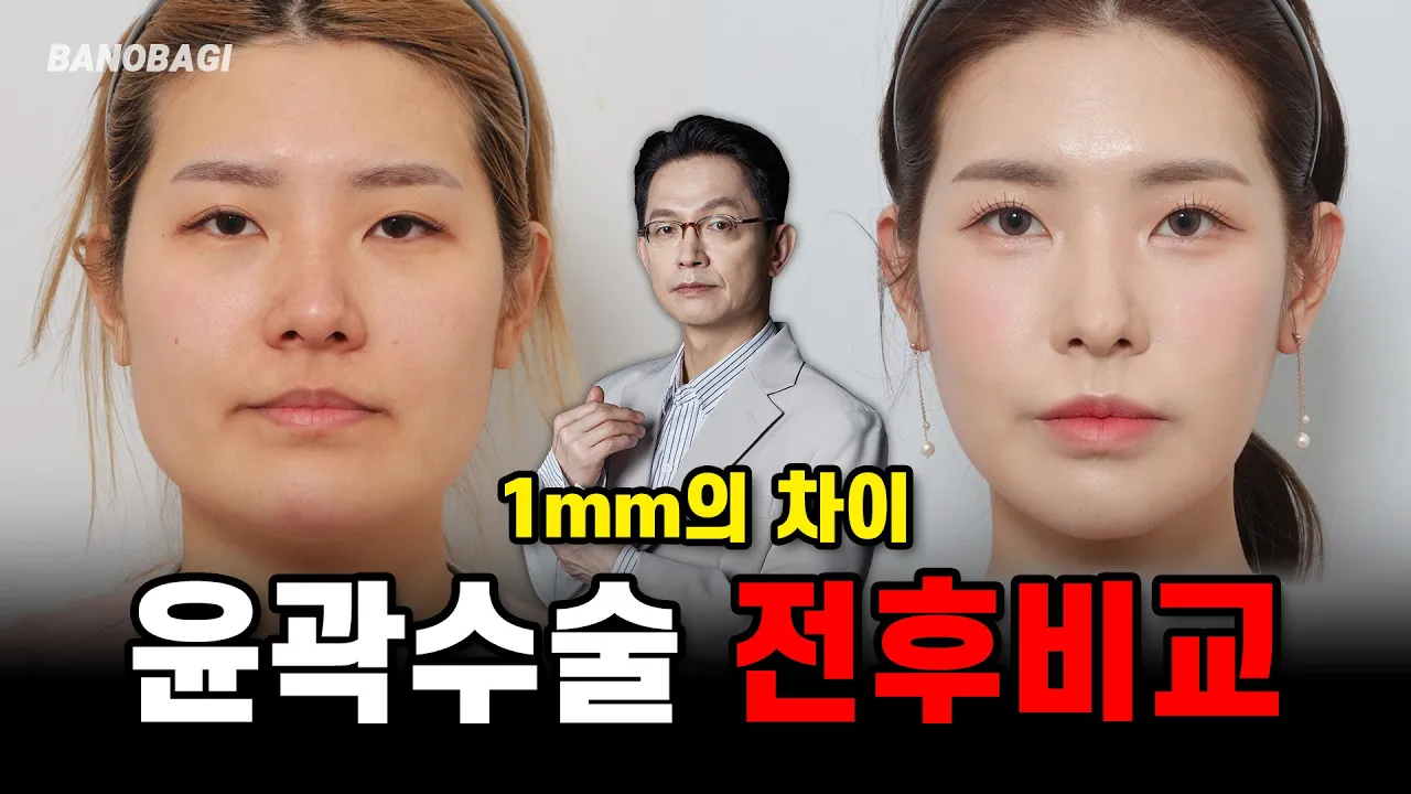 윤곽 3종...그 후..👧 1mm의 차이로 내 얼굴이 변한다? 윤곽수술 케이스 리뷰