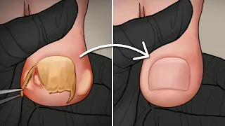 ASMR | Satisfying Ingrown Toenail Removal