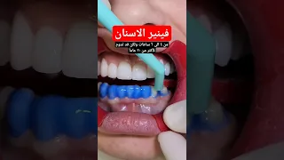 فينير الاسنان عملي ة دقيقة جد ا 