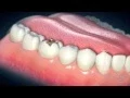 Dental Crowns Everything You Need to Know