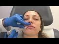 Lip filler treatment using Restylane Refyne by Dr Shaun Patel Miami Skin and Vein