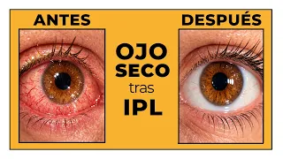 IPL para ojo seco: el MEJOR Tratamiento en la Actualidad (paso a paso de la Luz Pulsada Intensa)