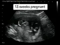 Download Lagu Baby Hand Bones on Ultrasound at 13 weeks pregnant #rochesternyultrasound #pregnancyultrasound #baby