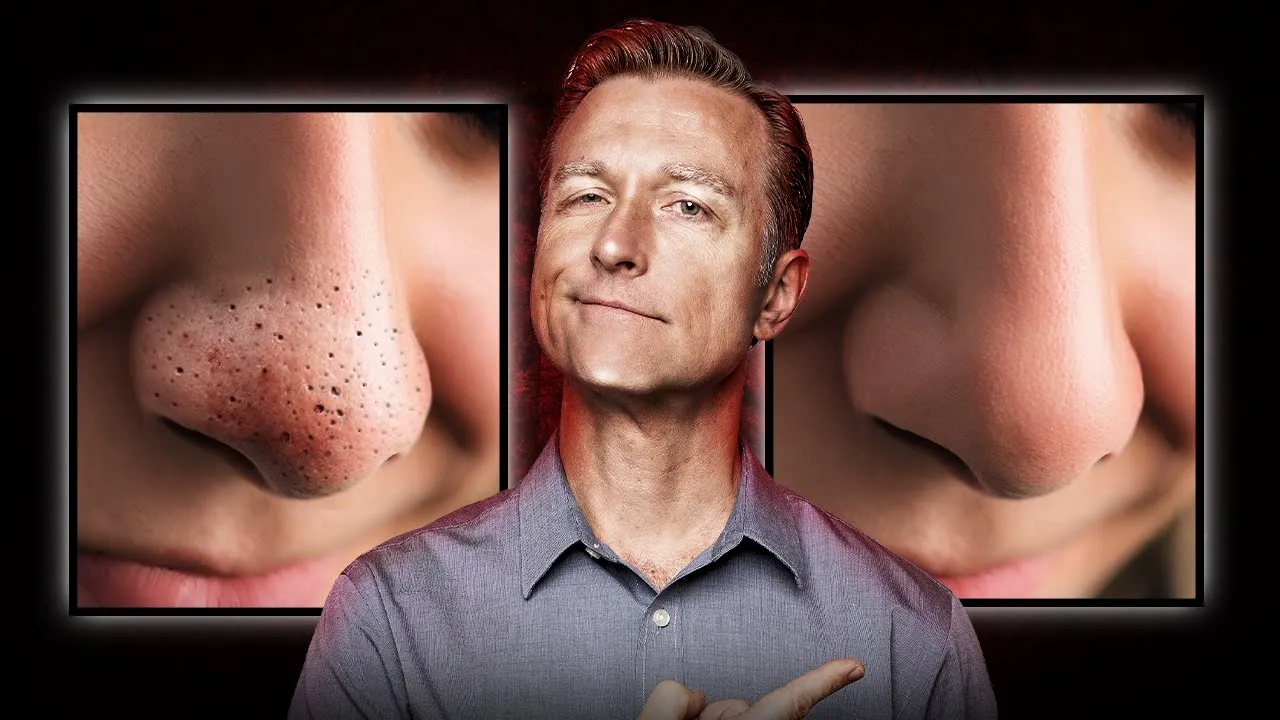 Outline Video How to Get Rid of Blackheads and Sebaceous Filaments - Dr. Berg