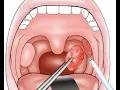 ADENOTONSILLECTOMY - INTRODUCTION ADENOTONSILLECTOMU TONSILLECTOMY PROCEDURE