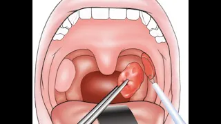 ADENOTONSILLECTOMY - INTRODUCTION ADENOTONSILLECTOMU TONSILLECTOMY PROCEDURE