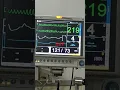 Download Lagu ventricular tachycardia in cardiac monitor