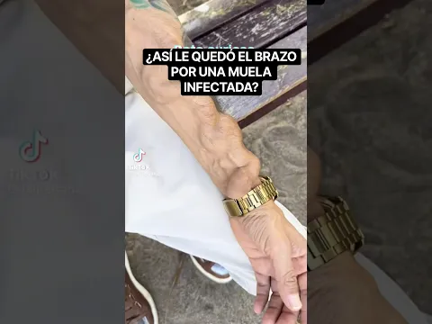 🔥 Le sacaron una muela infectada sin antibióticos y acabó en diálisis: ¿qué pasó realmente?