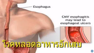 โรคหลอดอาหารอักเสบมีอาการอย่างไร  และสาเหตุที่ไม่ใช่กรดไหลย้อนมีอะไรบ้าง