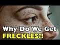 Why Do Some People Get Freckles