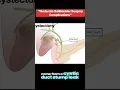 Complications of Cholecystectomy Bile Leaks Abscesses and Retained Stones
