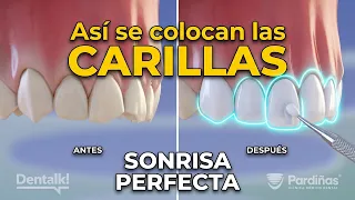¿Qué son las CARILLAS DENTALES? Guía visual completa