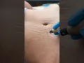Stretch Marks Inkless Removal Boleyn Treatment Los Angeles