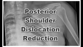 The Kona Posterior Shoulder Dislocation Reduction Technique