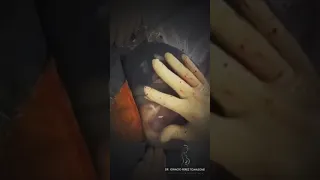 لحظة إزالة كيس الولادة البرنس أو كيس المشيمة عن جنين لحظة مدهشة سبحان الخلاق 