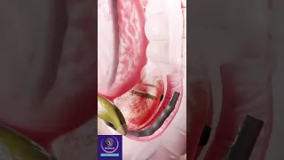 Stone Removal from Bile Ducts - ERCP Procedure