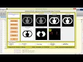 Lung Cancer Detection Using Image Processing Matlab Project with Source Code