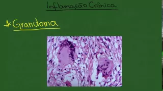 Inflamação Crônica - Resumo - Patologia Geral