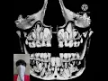 longest tooth in the world