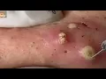 Large Blackheads Cystic Acne Blackheads Whiteheads Removal Pimple Popping