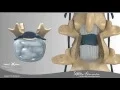 Lumbar Laminectomy and Fusion Presented by Swift Institute Reno Spine Surgeons and Spine Center