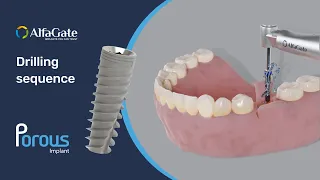 How to place Porous dental implant drilling sequence Alfa Gate