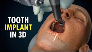 Dental Implant Procedure Explained with 3D Animation