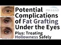 Why Fat Grafting is Not Advised Under the Eyes to Treat Hollowness and a Safer Treatment