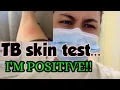 Life in Canada Nagpositive ako sa TB skin test