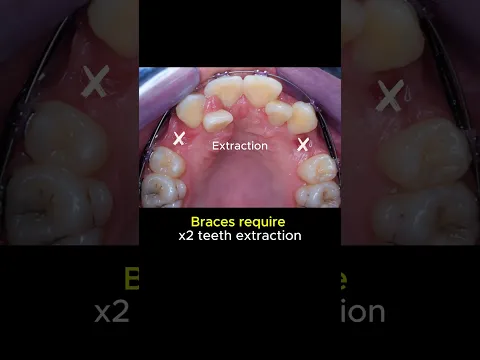 Braces for crowded teeth, require extraction #braces #orthodontist #dentist #teeth #orthodontics