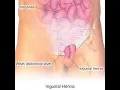 Repair Inguinal Hernia CPT code - simplify medical coding
