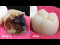 Incredible Restoration Of Tooth By Root Canal And Zirconia Crown.