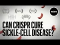 Can CRISPR cure Sickle-cell Disease