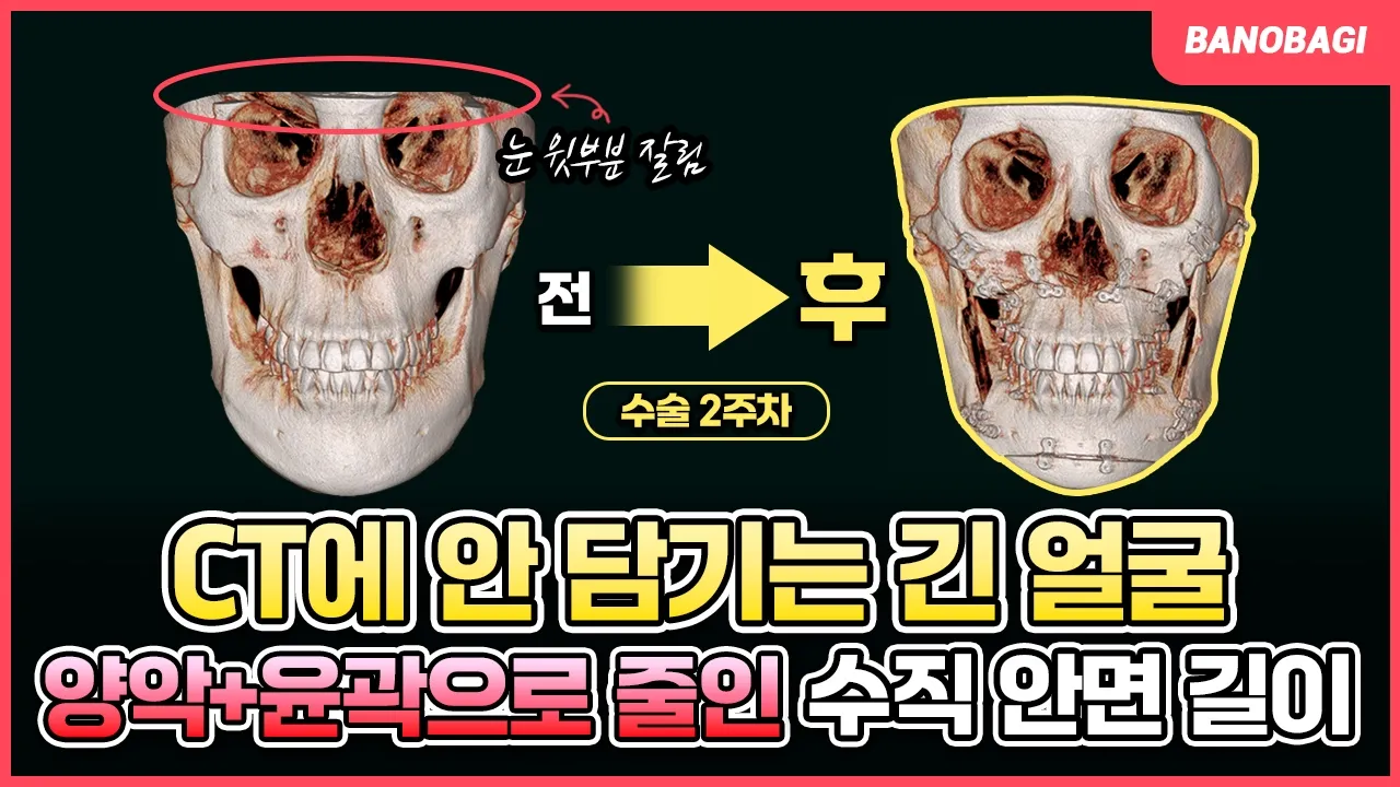 중안면과 하관이 너~무 긴 얼굴😭 양악수술과 윤곽수술로 해결💛 수술 전후 비교 케이스 리뷰🔥