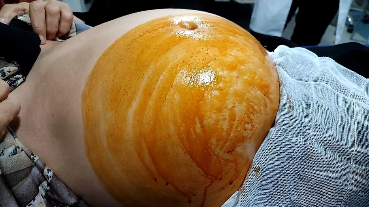 Remove 4000cc fluid from abdomen using ultrasound guide | Paracentesis