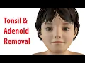 Tonsillectomy Adenoidectomy T A Rated G