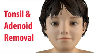Tonsillectomy Adenoidectomy T A Rated G