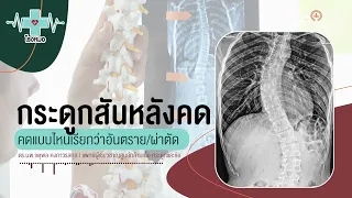 หลังคดมากกว่า 50 องศาจะมีปัญหาอะไร