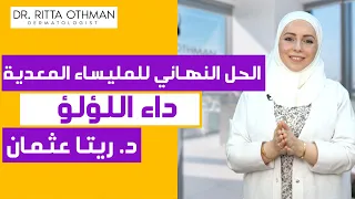 Molluscum داء اللؤلؤ العلاج النهائي المليساء السارية المليساء المعدية 