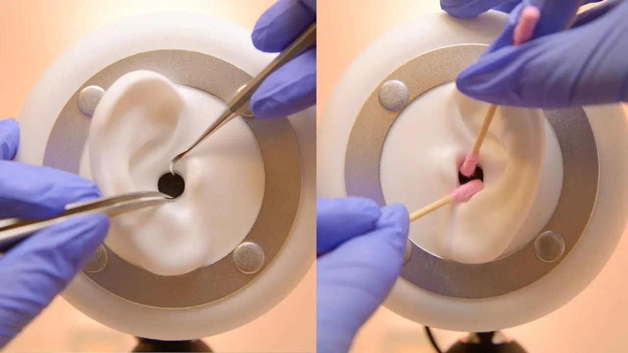 Video showing 12 cotton wool balls being removed from a patients ears. The patient attended our ear . 