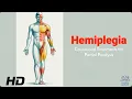 Hemiplegia 101 Identifying Causes and Exploring Effective Therapies