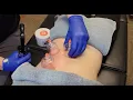 Learn about CUPPING THERAPY for Mid and Low Back Pain prochiropractic Dr Jon Wilhelm Bozeman MT