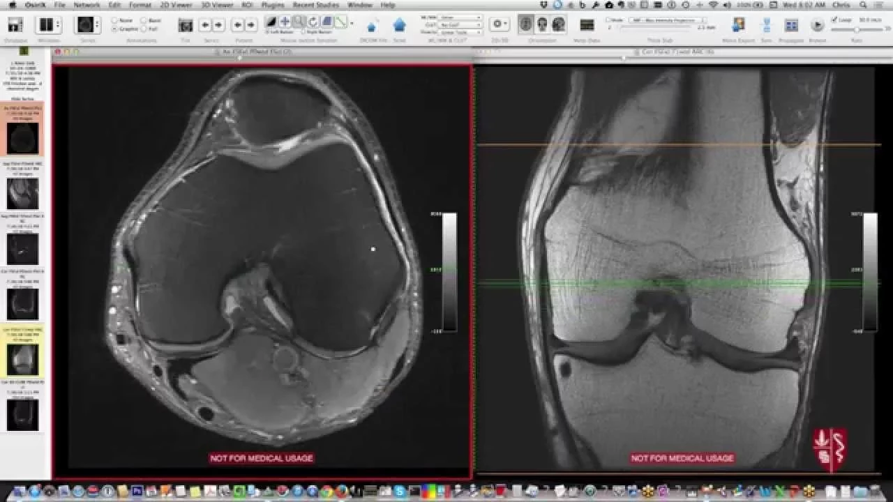 PSLD indication. No limitation of anatomical variations.. 
