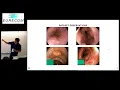 Automatic Hyperparameter Optimization in Keras for the MediaEval 2018 Medico Multimedia Task
