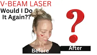Download MY V-BEAM LASER EXPERIENCE: Would I Do It Again MP3