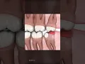 Lagu Should You Remove Wisdom Teeth?